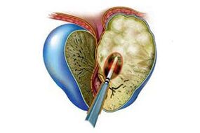 akut prostatitin tezahürü