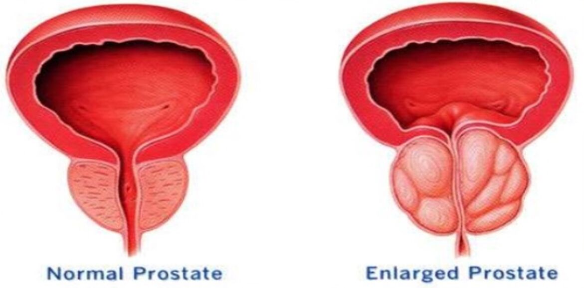 Normal prostat, iltihaplı prostat